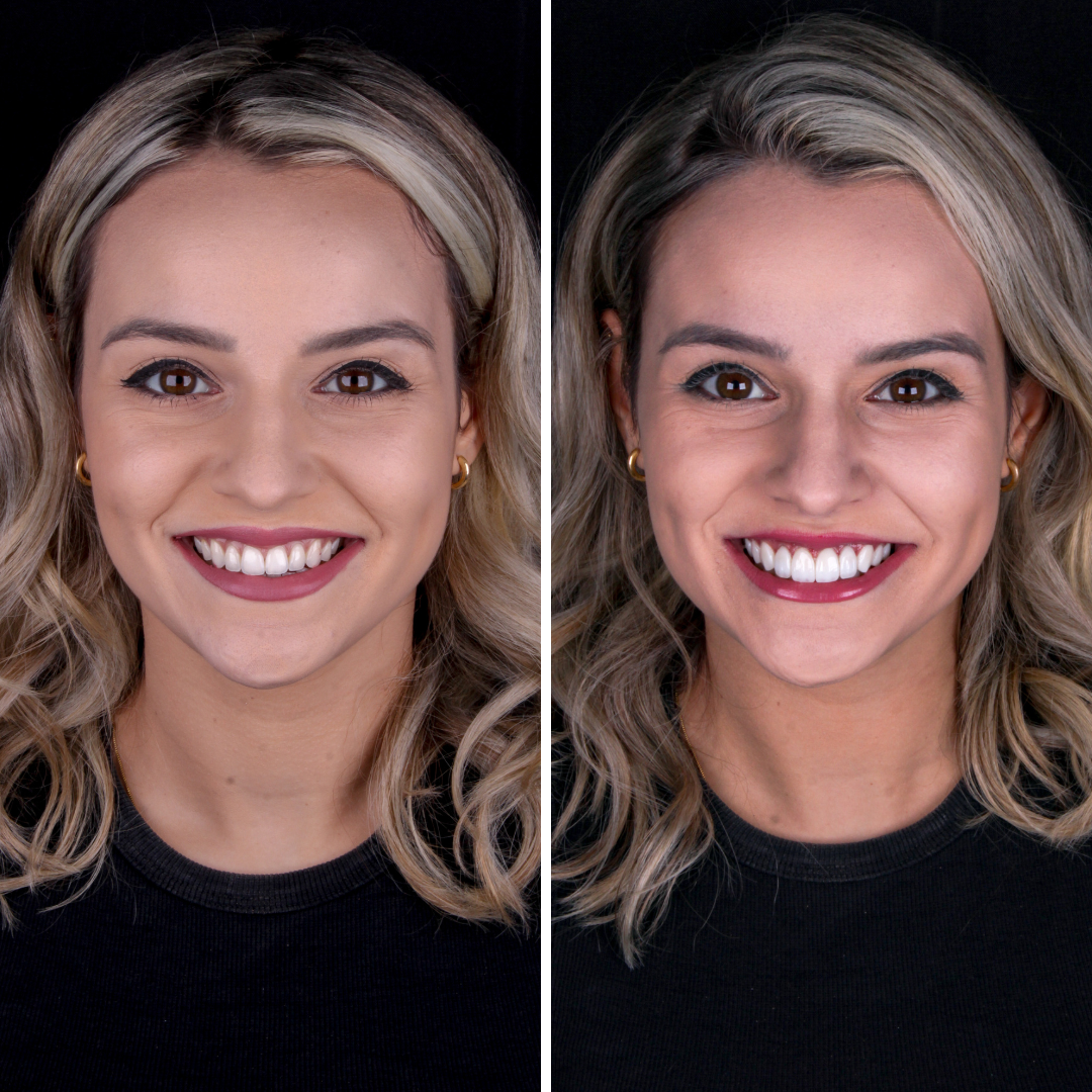 Imagem 01 dos dentes do paciente após o tratamento dentário, mostrando um resultado satisfatório. Os dentes exibem uma aparência saudável, alinhada e com uma coloração natural, refletindo o sucesso do procedimento odontológico.